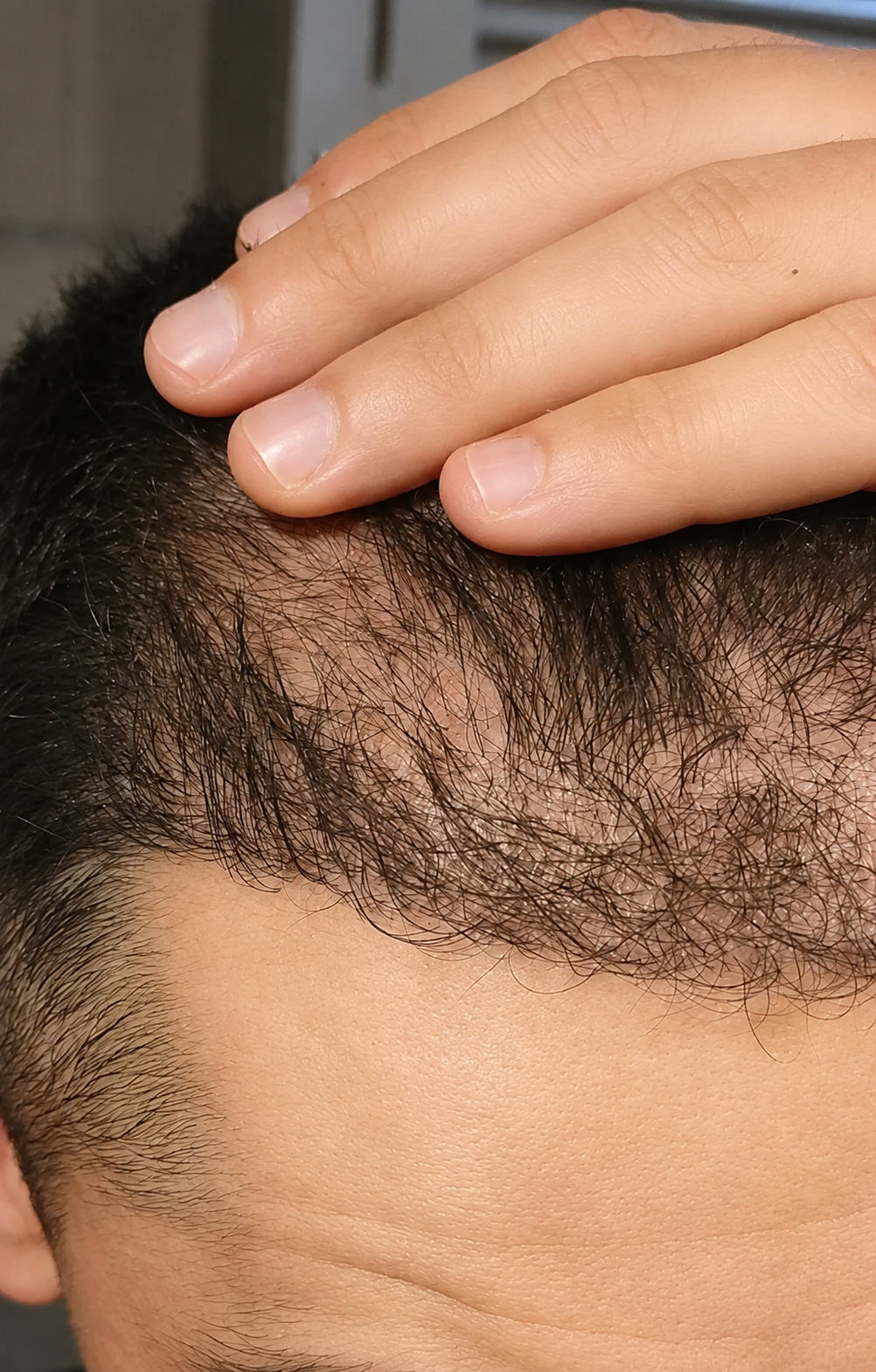 Slow, patchy growth at the hairline